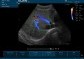 241442 - EDAN U50 - přenosný ultrazvuk s barevným dopplerem