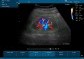 241442 - EDAN U50 - přenosný ultrazvuk s barevným dopplerem